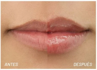 Voluminizador de Labios